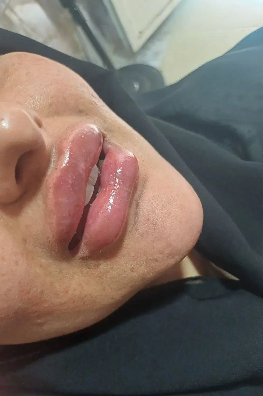 آف ویژه ژل بوتاکس مزو|خدمات آرایشگری و زیبایی|اسلامآباد غرب, |دیوار