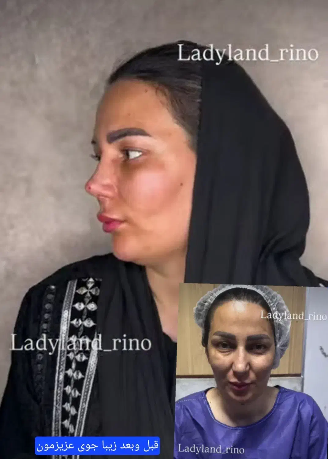 جشنواره جراحی بینی۲۵ تومن .جراحی صورت واندام|خدمات آرایشگری و زیبایی|اسلامشهر, شهرک مهدیه|دیوار