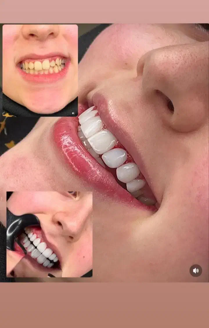 افر ویژه کامپوزیت دندان مواد تضمینی و اصلی|خدمات آرایشگری و زیبایی|کرج, گوهردشت|دیوار