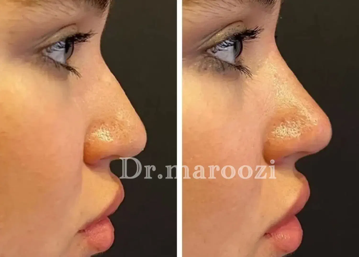 ژل لب فیلر بوتاکس مزو مادلینگ آنزیم بینی لیفتMD|خدمات آرایشگری و زیبایی|تهران, سردارجنگل|دیوار