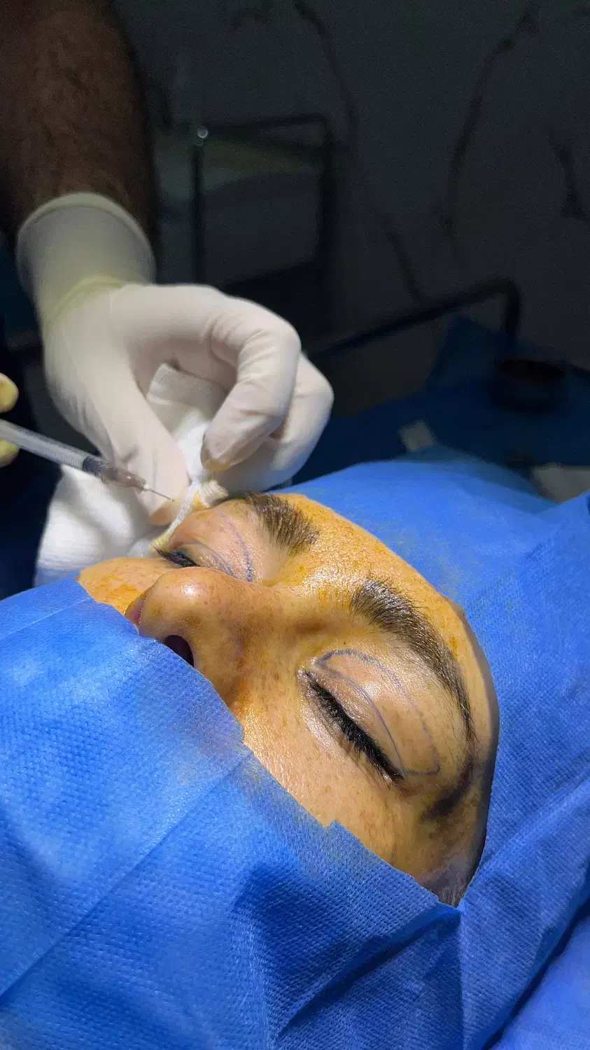 تخفیف ویژه شب یلدا برای جراحی بلفاروپلاستی|خدمات آرایشگری و زیبایی|مسجد سلیمان, |دیوار