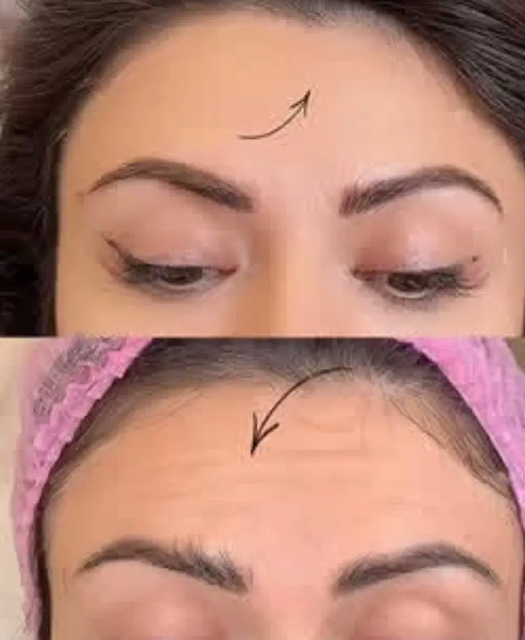 مدل برای فیلر و بوتاکس فقط هزینه موادگرفته میشود|خدمات زیبایی و سلامت|کرج, گلشهر|دیوار