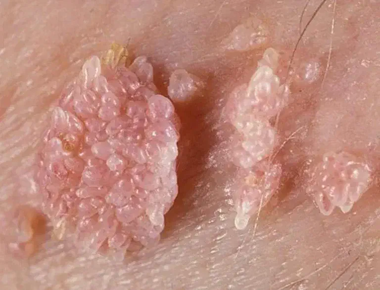 بهبود زگیل تناسلی|آرایشی، بهداشتی، درمانی|کیش, |دیوار