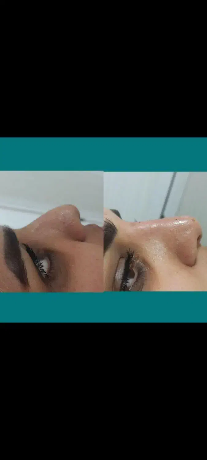 انواع خدمات ژل بوتاکس انزیم تخفیف ویژه|خدمات آرایشگری و زیبایی|کوهدشت, |دیوار