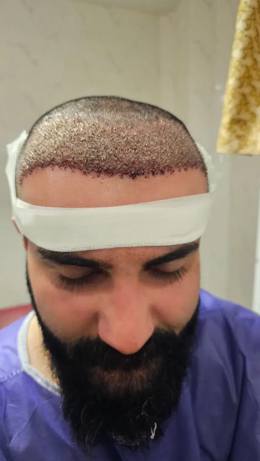 لیدر کاشت مو|استخدام درمانی، زیبایی، بهداشتی|یاسوج, |دیوار