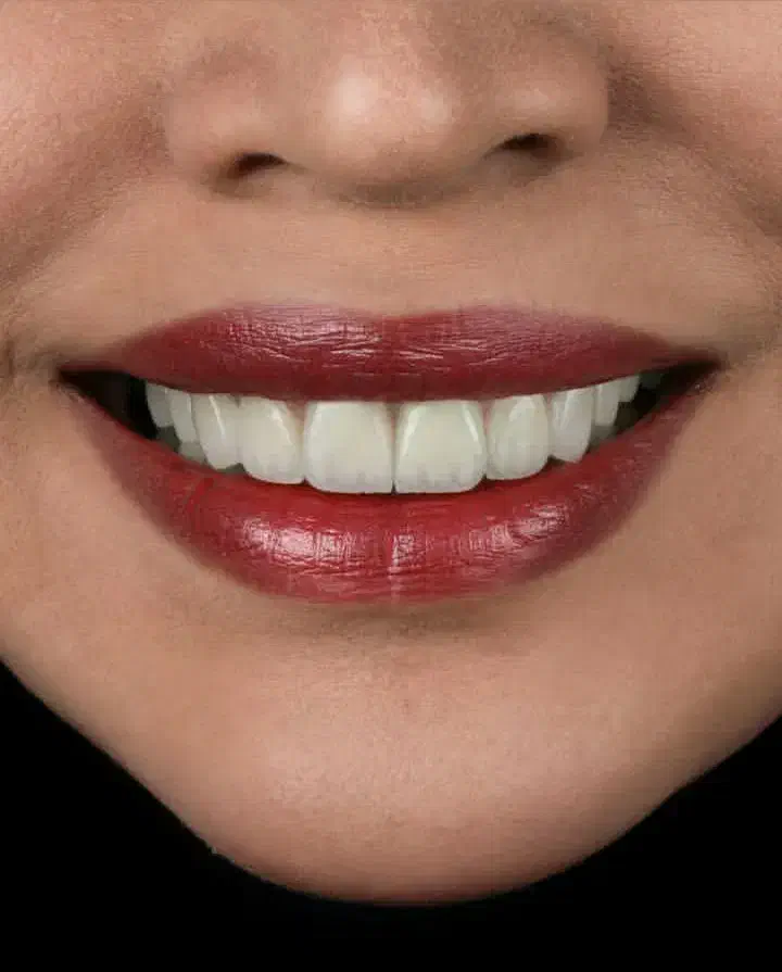 دندانپزشکی از دم قسط ایمپلنت کامپوزیت عصبکشی روکش|خدمات آرایشگری و زیبایی|خرمآباد, |دیوار