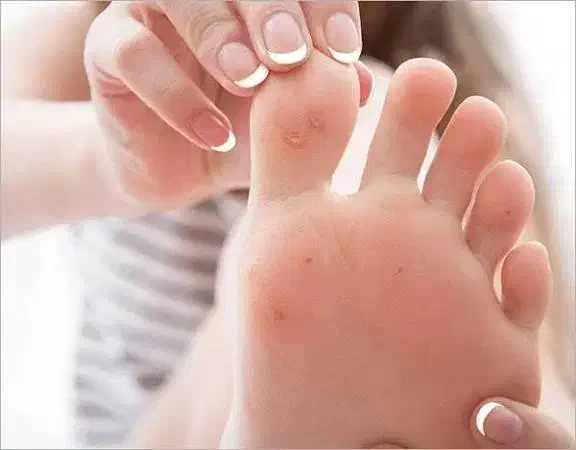 برداشتن زگیل و میخچه در یک جلسه|خدمات آرایشگری و زیبایی|قم, نیروگاه|دیوار
