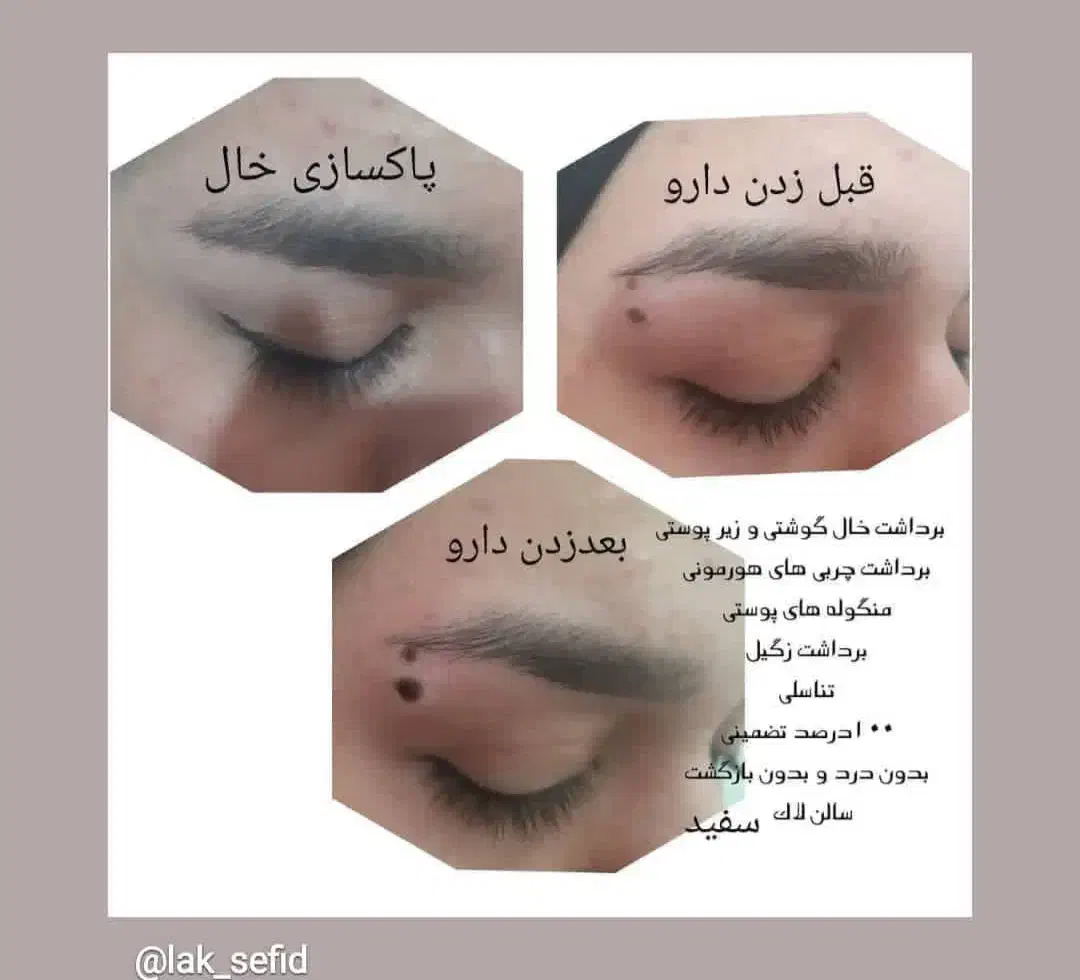 پوست زیبایی|خدمات آرایشگری و زیبایی|رباط‌کریم, الارد|دیوار