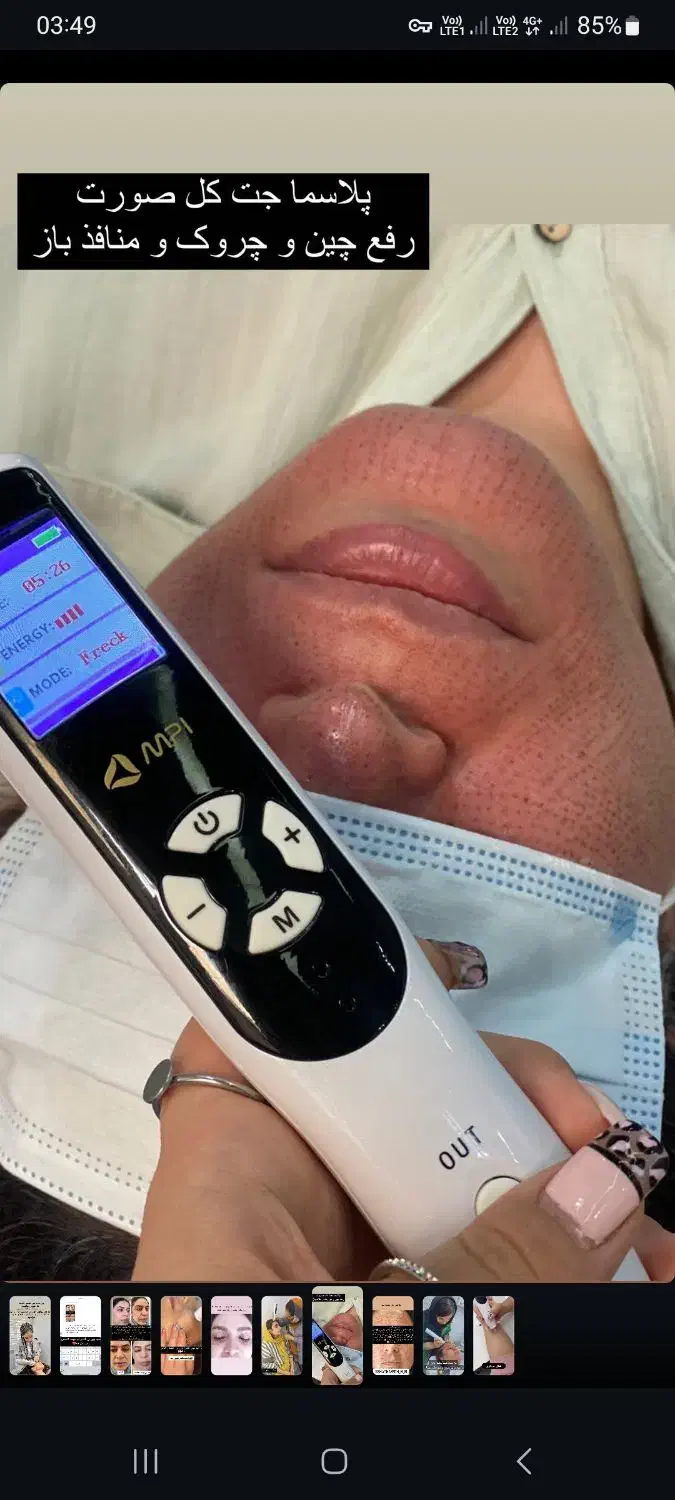 دستگاه لیزر، کربن تراپی، ریمو تتو، دستگاه سم زدایی|پزشکی|سنندج, |دیوار