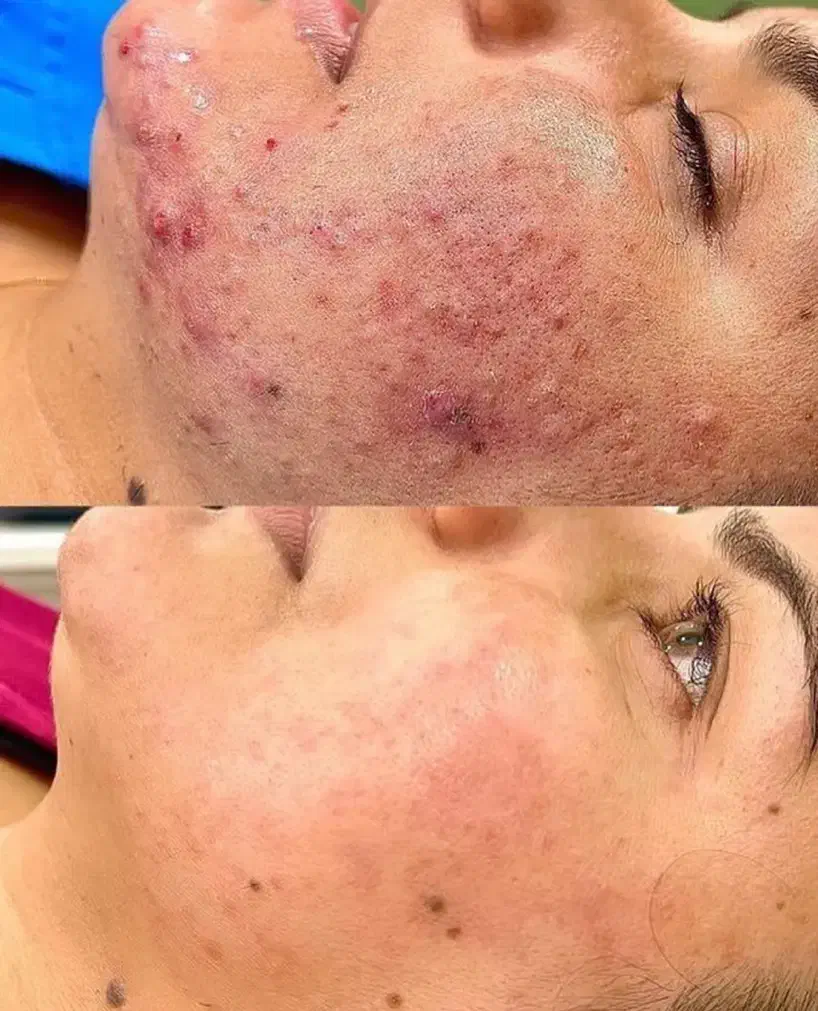 هایفوتراپی و فشیال پوست کره ای|خدمات آرایشگری و زیبایی|یزد, |دیوار