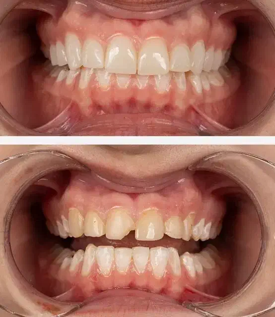 شرایط ویژه کامپوزیت دندان|خدمات آرایشگری و زیبایی|آذرشهر, |دیوار