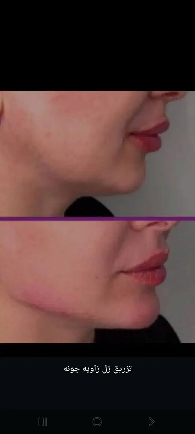 انجام ژل و بوتاکس با بهترین مواد اقساطی|خدمات آرایشگری و زیبایی|آزادشهر, |دیوار