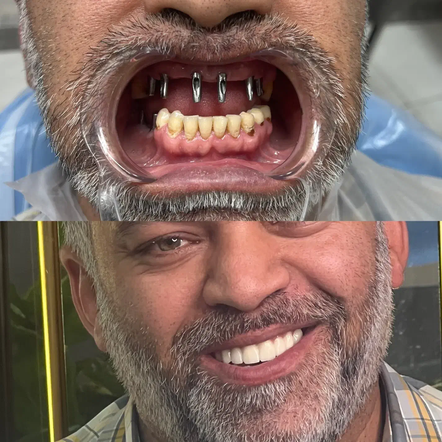 ایمپلنت دیجیتال|خدمات آرایشگری و زیبایی|قم, نیروگاه|دیوار