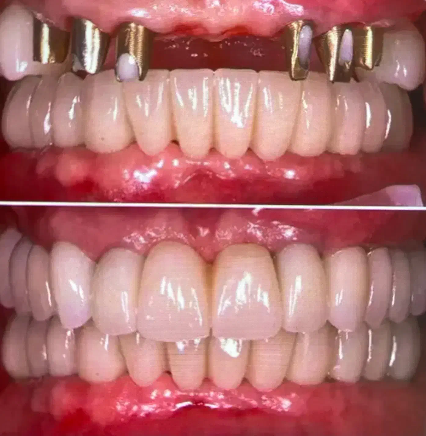 ایمپلنت سوئدی با روکش ۱۴/۹۰۰|خدمات آرایشگری و زیبایی|تهران, صادقیه|دیوار