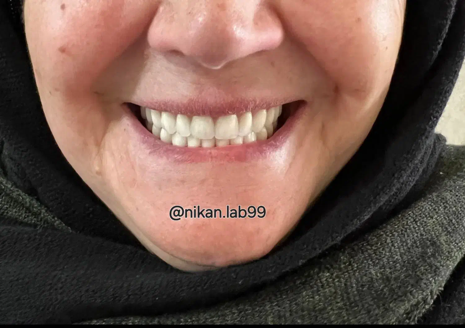 دندانسازی دندان مصنوعی تحویل ۲روزه باضمانت|خدمات آرایشگری و زیبایی|اصفهان, کشاورزی|دیوار