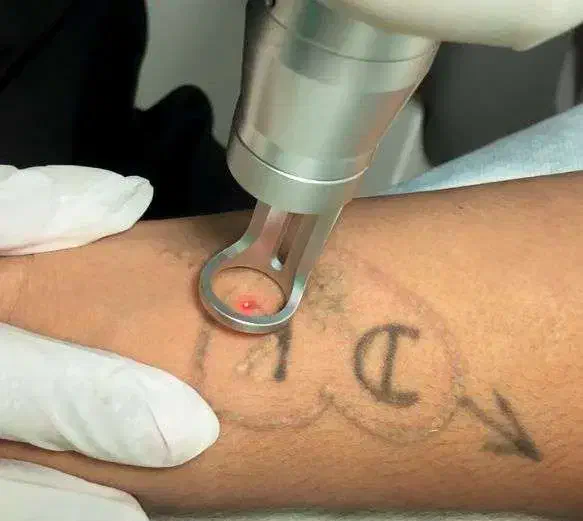 پاک کردن تتو ،خالکوبی و کک و‌مک با لیزر|آرایشگاه و سالن‌های زیبایی|زابل, |دیوار