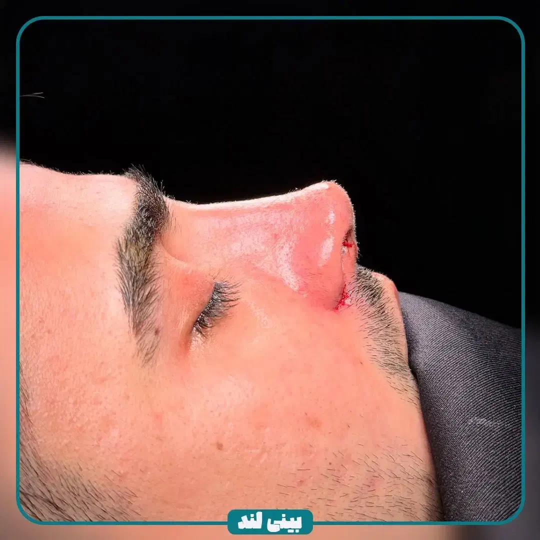 جشنواره تخفیفات جراحی بینی/عمل بینی|خدمات آرایشگری و زیبایی|کاشان, الغدیر|دیوار