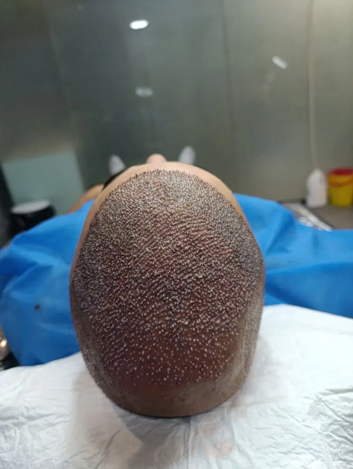 کاشت مو به روش Sp|خدمات آرایشگری و زیبایی|آذرشهر, |دیوار