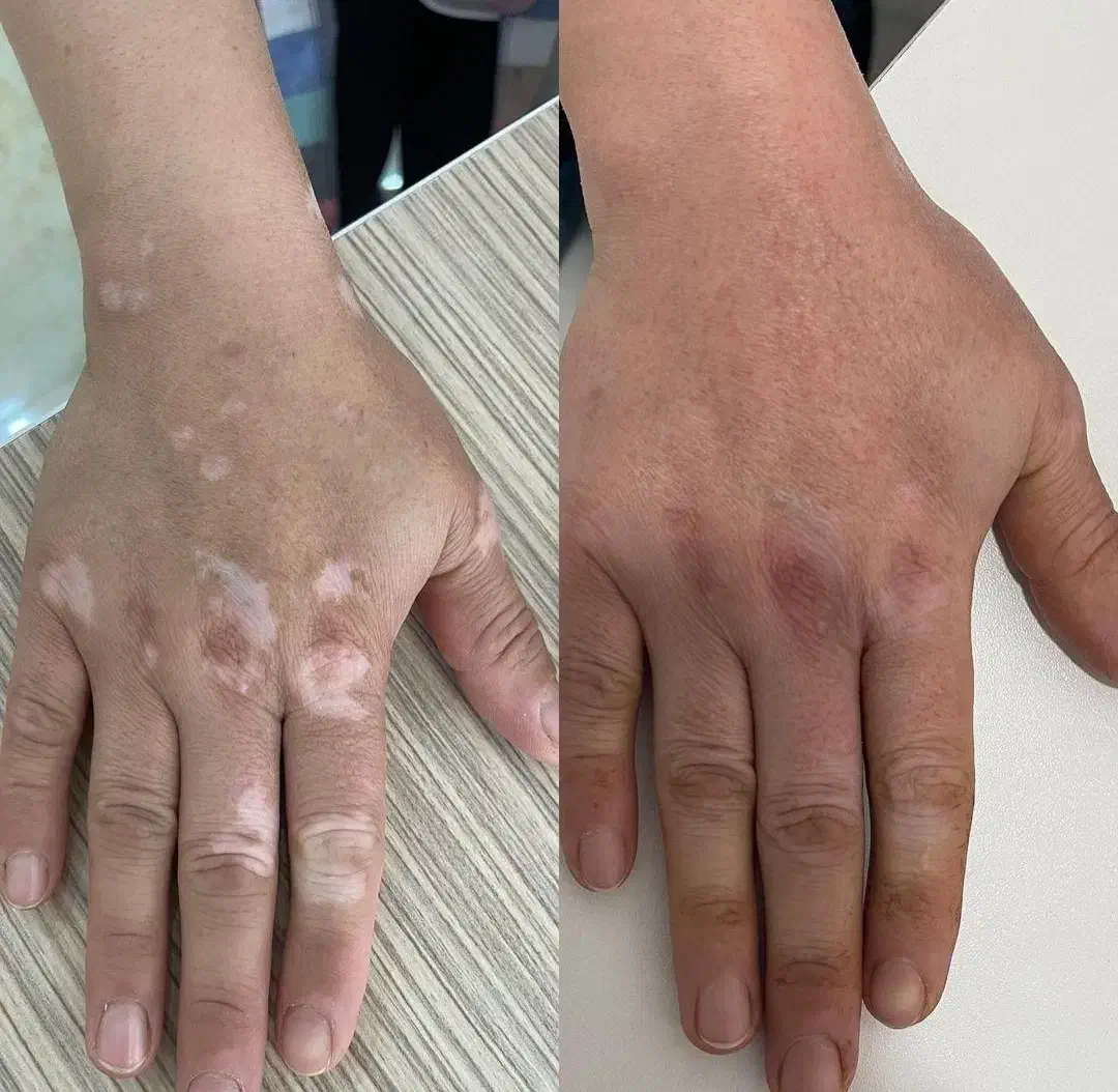 درمان دائمی بیماری پوستی خود ایمنی|خدمات آرایشگری و زیبایی|کوهنجان, |دیوار