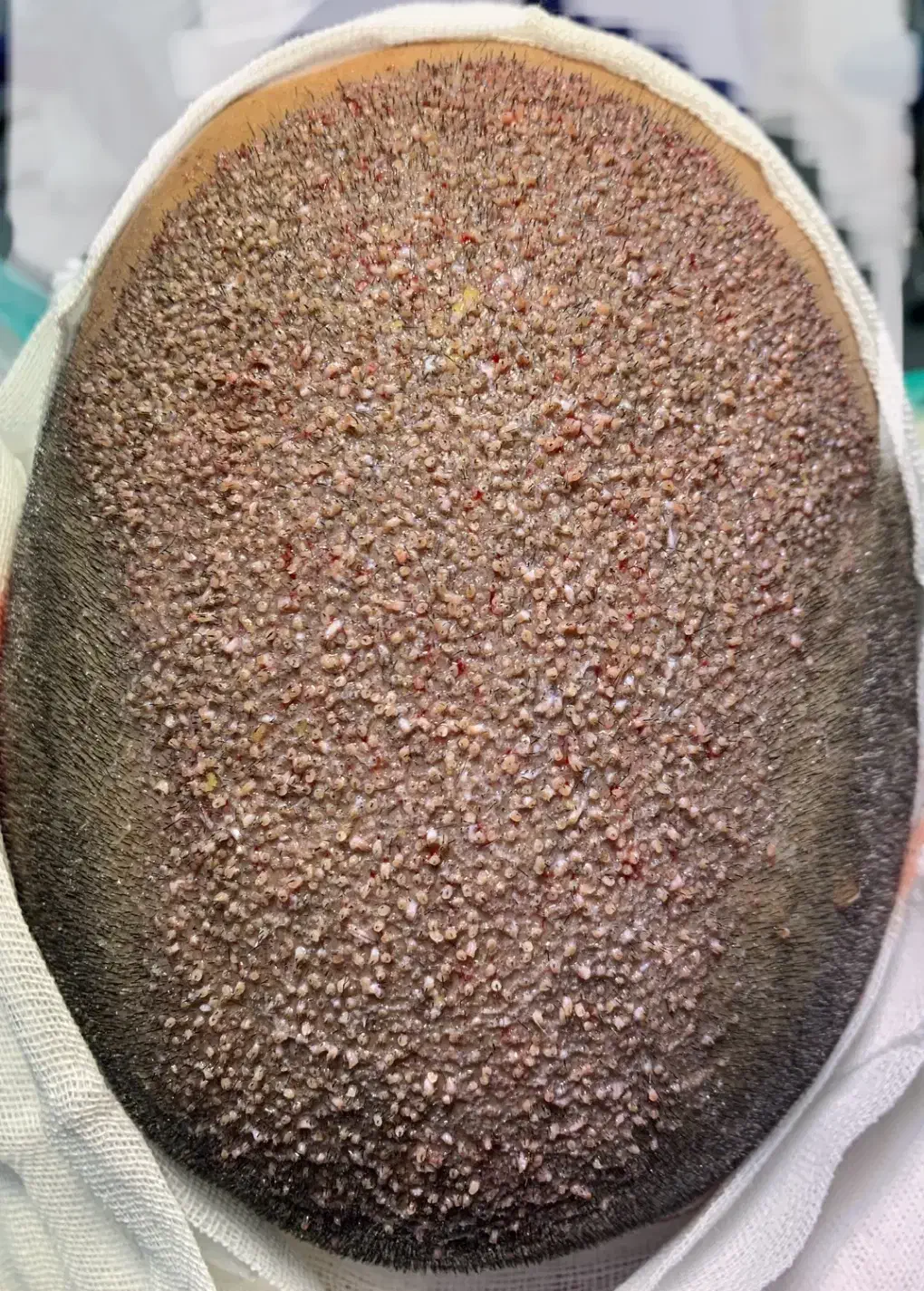 کاشت مو اقساطی بدون سود|خدمات آرایشگری و زیبایی|مشهد, هنرستان|دیوار