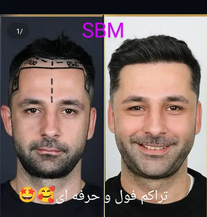 کاشت فوق حرفه/جدیدترین متدسوپرمیکروit+ مو/ابرو/ریش|خدمات آرایشگری و زیبایی|مشهد, هفت تیر (آب و برق)|دیوار