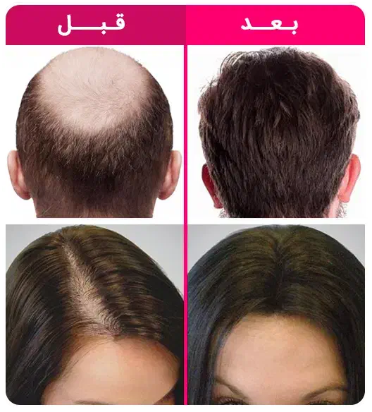 مشاوره رویش مجدد مو آقایان رایگان انجام میشه|فعالیت داوطلبانه|مشهد, آزادشهر|دیوار