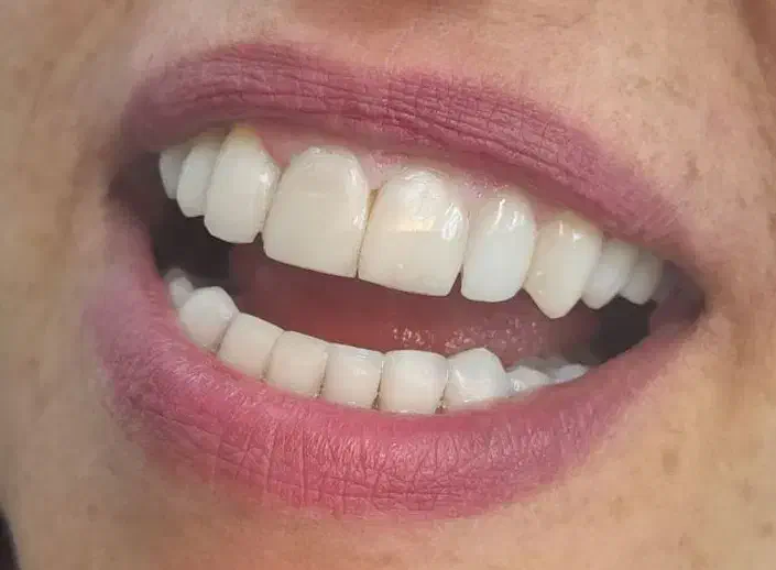 لبخند طلایی با دندون طلا|خدمات آرایشگری و زیبایی|تهران, آذربایجان|دیوار