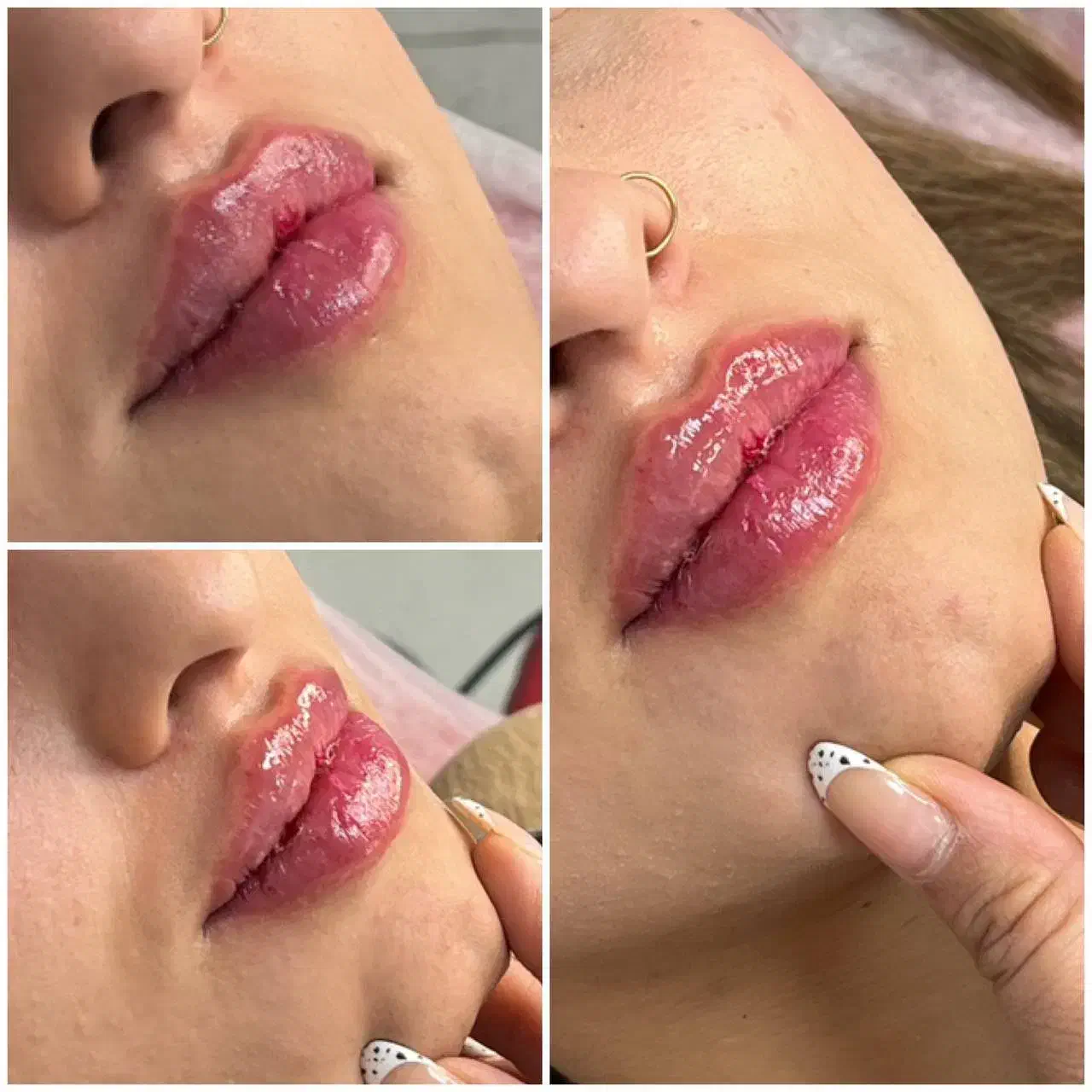 بوتاکس،فیلر توسط پزشک پوست و زیبایی(تخفیف استثنایی|خدمات آرایشگری و زیبایی|تهران, دروس|دیوار