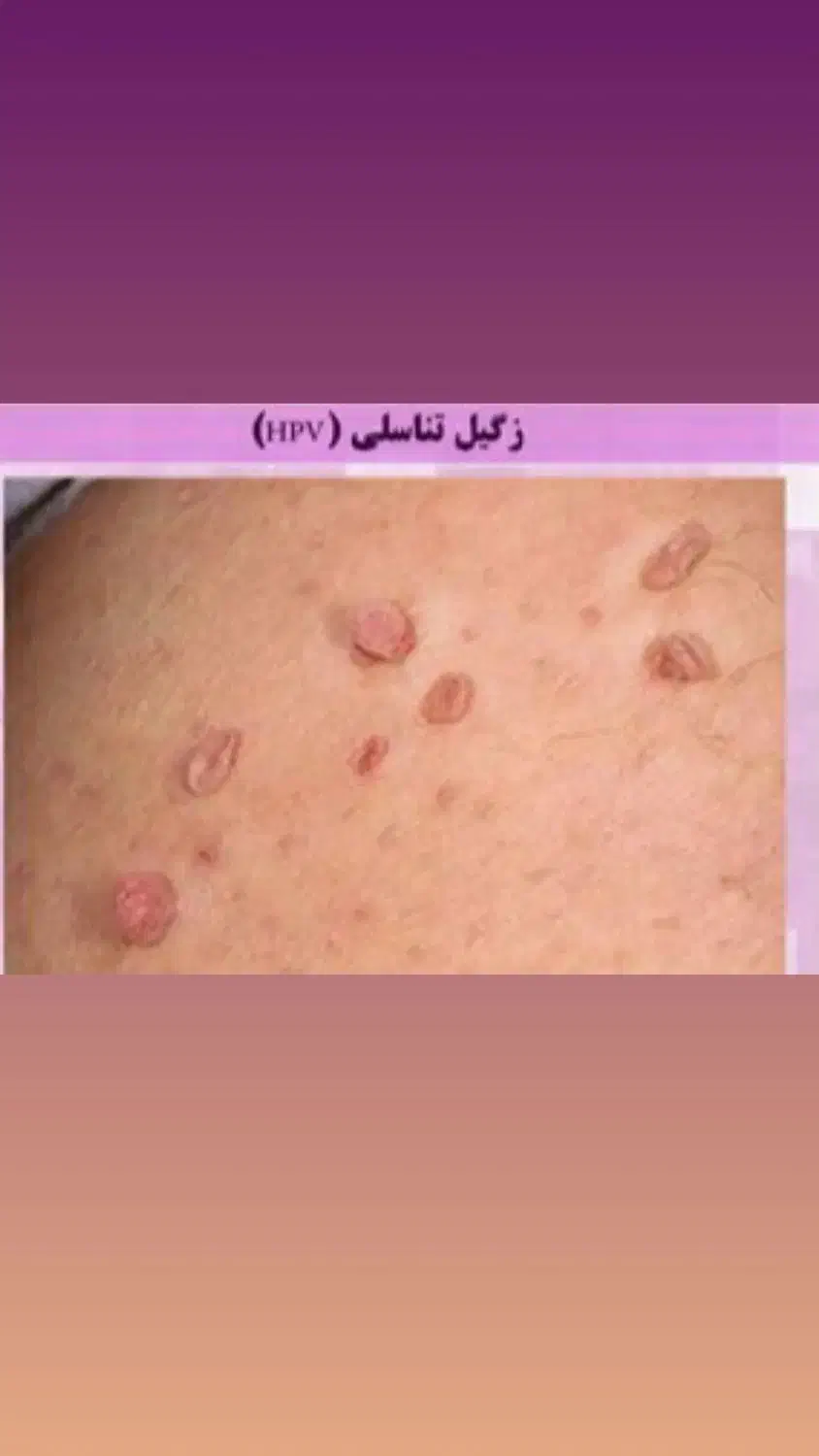 برداشتن زگیل تناسلی با قیمت پایین|خدمات آرایشگری و زیبایی|محمدیه-قزوین, |دیوار