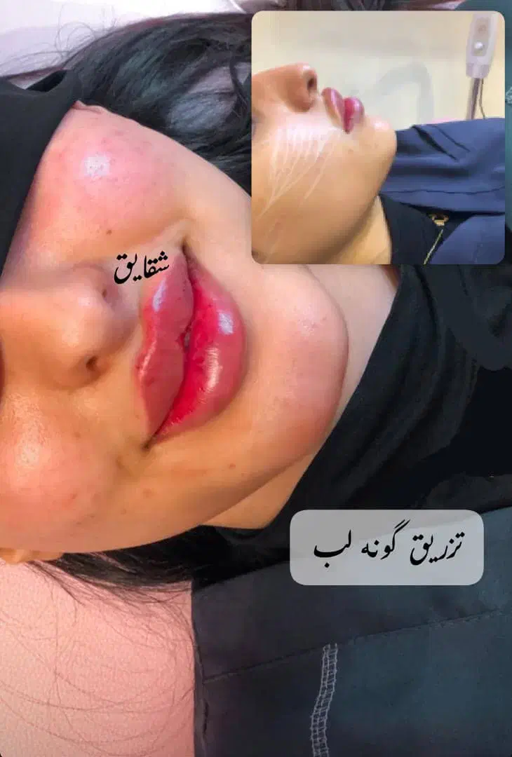 تخفیف اقتصادی ژل بوتاکس|خدمات آرایشگری و زیبایی|آبادان, |دیوار