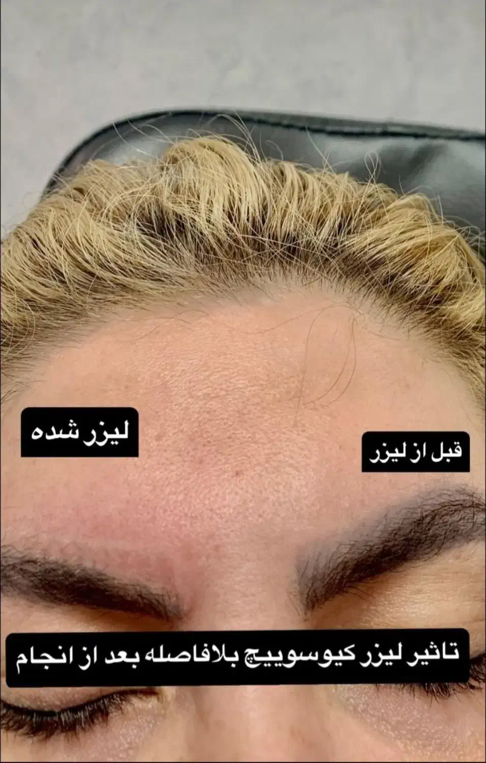 کربن تراپی لیزر کیوسوئیچ بستن منافذ|خدمات آرایشگری و زیبایی|دهدشت, |دیوار