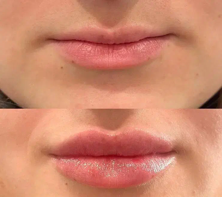 تزریق ژل و بوتاکس|خدمات آرایشگری و زیبایی|کرج, گلشهر|دیوار