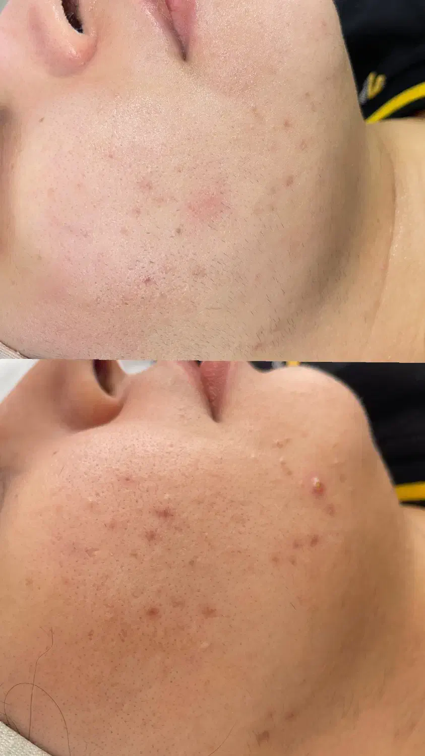 فیشیال تخصصی و درمانی پوست|خدمات آرایشگری و زیبایی|آمل, |دیوار