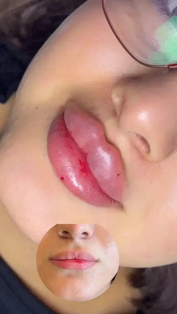 جشنواره فیلر و بوتاکس با بهترین متریال|خدمات آرایشگری و زیبایی|یزد, |دیوار