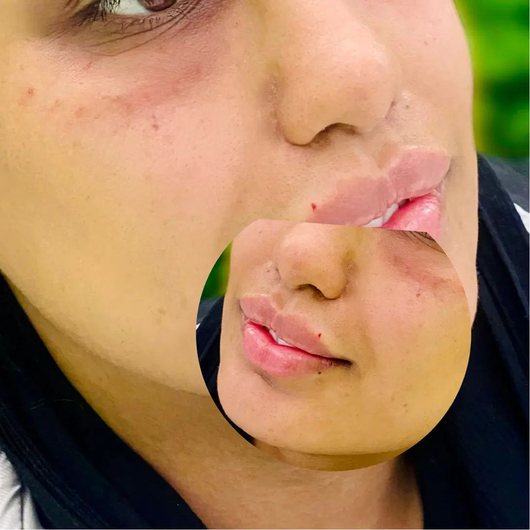 جشنواره فیلر ژل لب بوتاکس لیفت بانخ پی ار پی مزوژل|خدمات زیبایی و سلامت|تهران, کیانشهر|دیوار