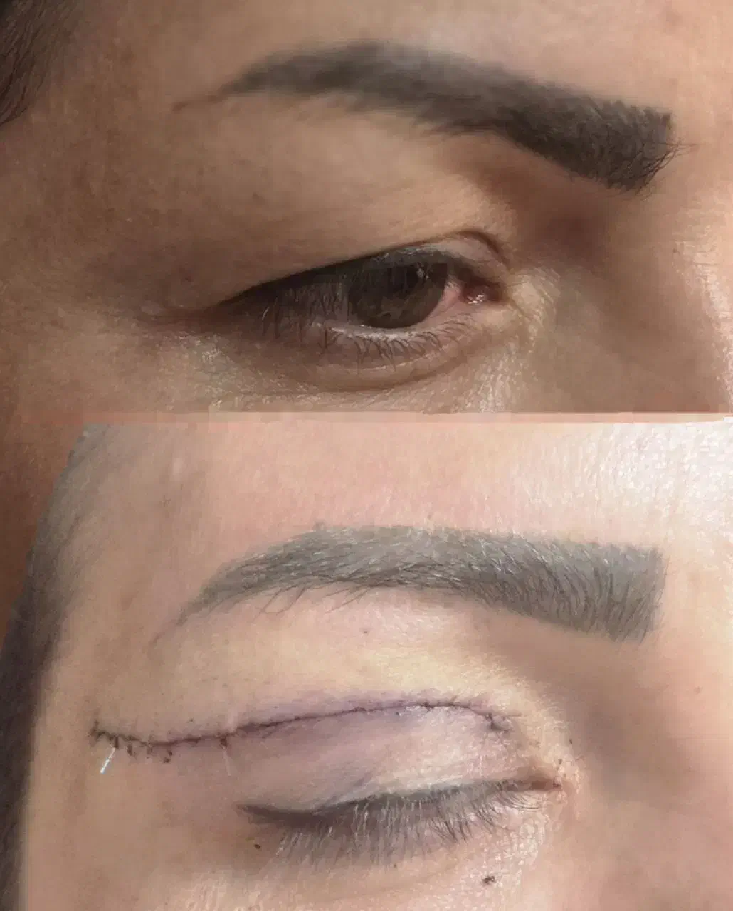 جشنواره بلفاروپلاستی جراحی پلک با بخیه لیزری|خدمات آرایشگری و زیبایی|تهران, شهرک غرب|دیوار