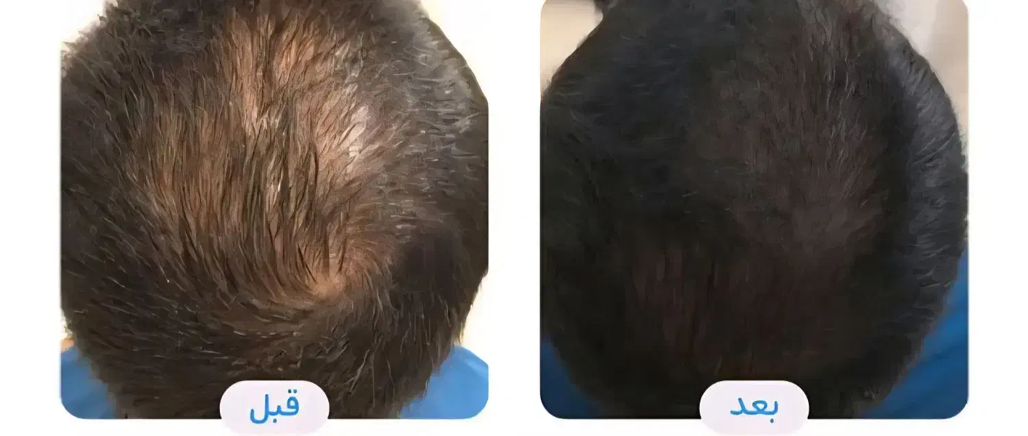 مزوتراپی و پی آر پی مو و ابرو|خدمات آرایشگری و زیبایی|اردبیل, |دیوار