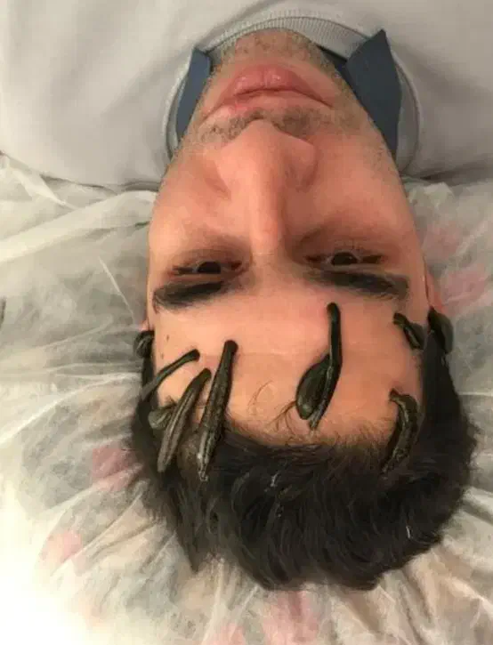 مشاوره حجامت و بادکش گرم زالو فصد خون امبدینگ|خدمات آرایشگری و زیبایی|اصفهان, بهارستان (مخابرات)|دیوار