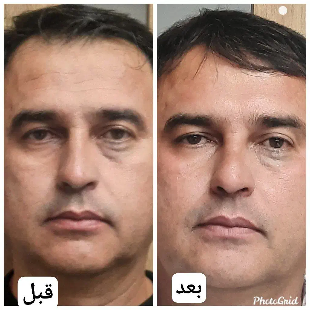 تنهامرکزلیفت صورت،بابیشترین تعدادنخاردارونخبدونخار|خدمات آرایشگری و زیبایی|مشهد, نیروی هوایی|دیوار