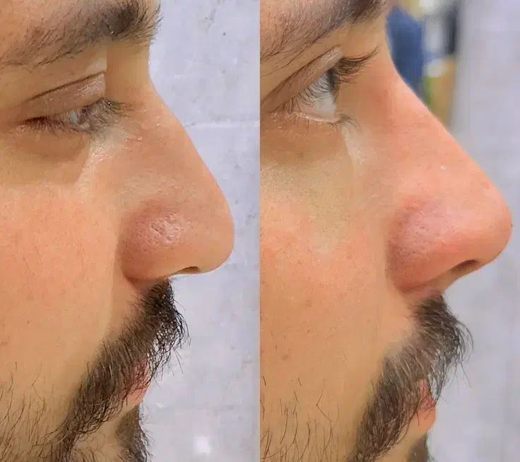 عمل زیبایی بینی|خدمات آرایشگری و زیبایی|حمیدیه, |دیوار