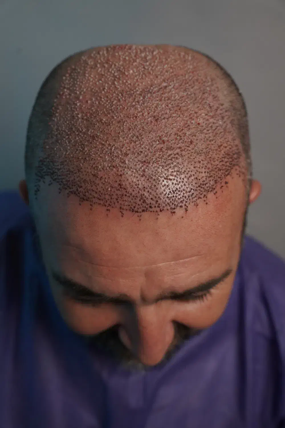 کاشت تخصصی مو به روش FIT|خدمات آرایشگری و زیبایی|رشت, گلسار|دیوار