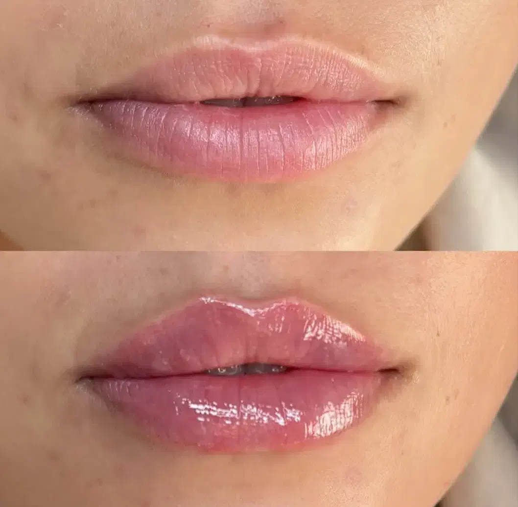 ژل .بوتاکس.انزیم،انواع پرسینگ .چال لپ|خدمات آرایشگری و زیبایی|ملایر, |دیوار