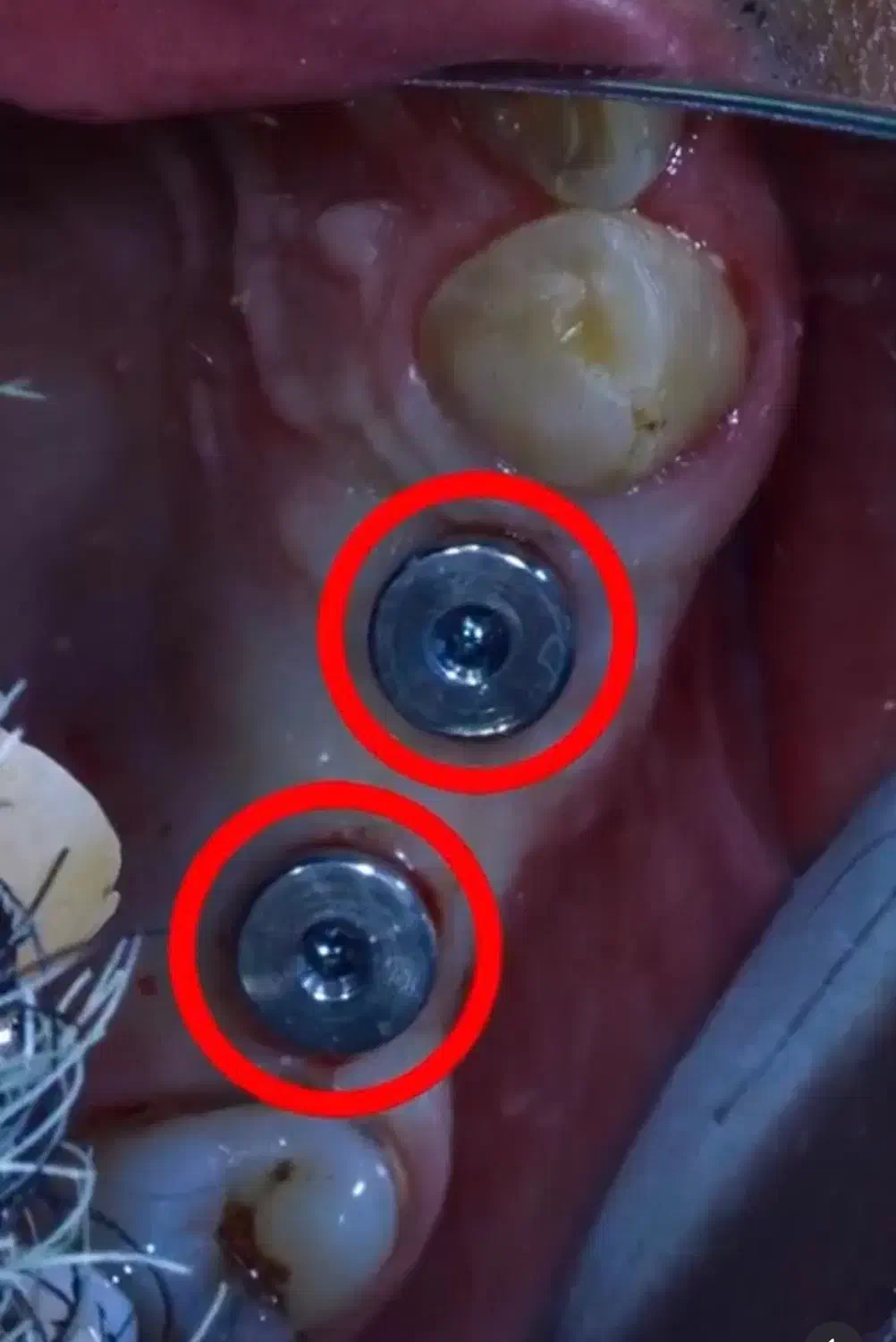 مرکزتخصصی ایمپلنت بدون دردو خونریزی/وام قرض الحسنه|خدمات آرایشگری و زیبایی|اصفهان, ملک|دیوار