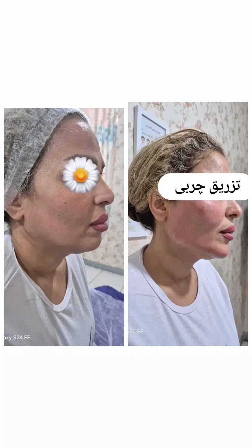 ساکشن غبغب تزریق چربی ۲م فقط پنجشنبه و جمعه|خدمات آرایشگری و زیبایی|اهواز, امانیه|دیوار