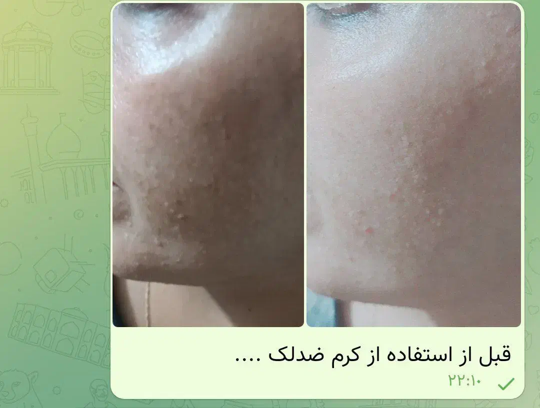 کرم جوانسازی و ضد لک|آرایشی، بهداشتی، درمانی|گرگان, |دیوار