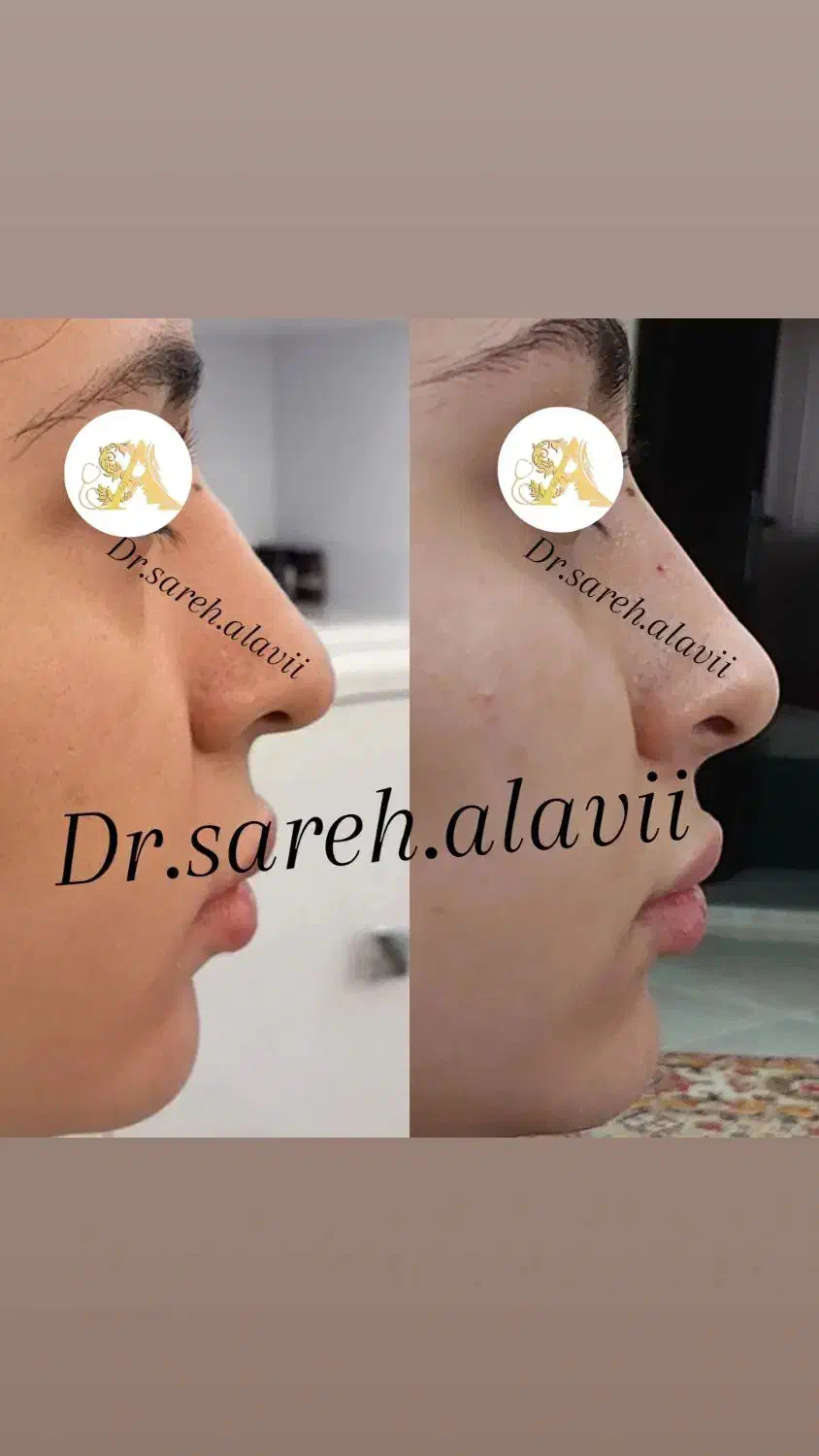 اصلاح فرم و کوچک کردن بینی توسط پزشک بدون جراحی|خدمات آرایشگری و زیبایی|قم, دورشهر|دیوار