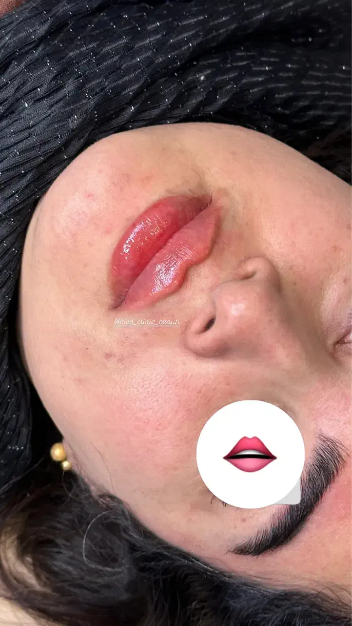 آموزش،پی ار پی مزوبوتاکس بایوفیلر غبغب چربی ساکشن|خدمات آرایشگری و زیبایی|اصفهان, شاهزید|دیوار