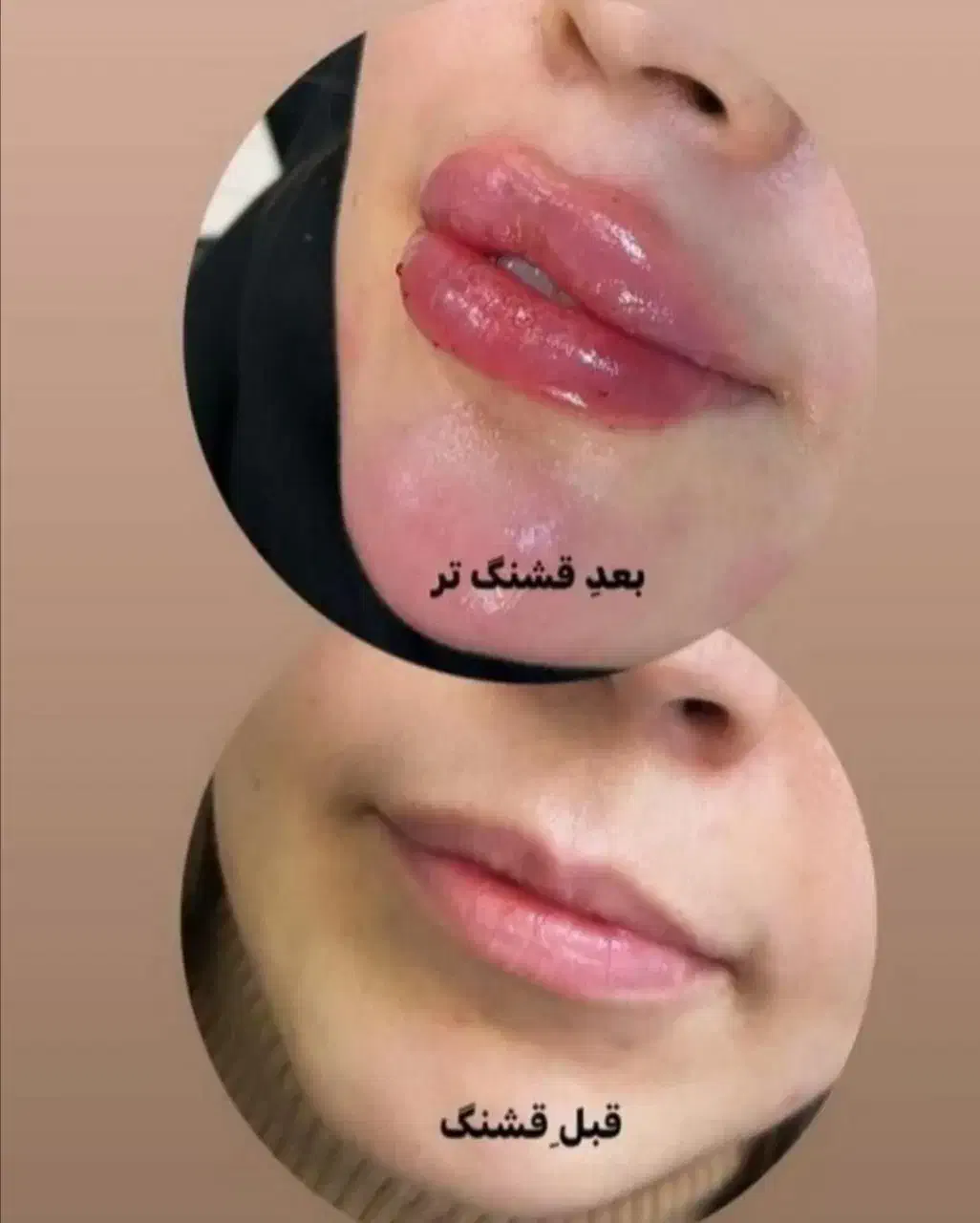 (کلینیک زیبایی) فیلر،بوتاکس مزوژل جوانساز، ضدلک|خدمات آرایشگری و زیبایی|قشم, |دیوار