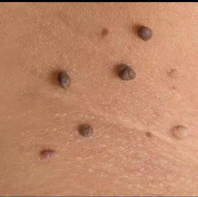 hpv/hsv|آرایشی، بهداشتی، درمانی|بندر ماهشهر, |دیوار