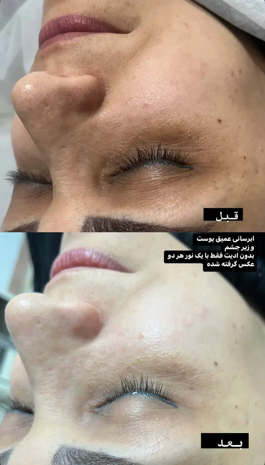 پاکسازی صورت ۲۵۰ تومن|خدمات آرایشگری و زیبایی|لاهیجان, کوی استادان|دیوار